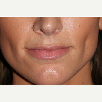 25-34 year old woman treated with Juvederm before 3185366