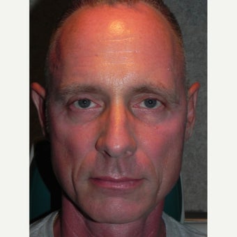 45-54 year old man treated with Sculptra before 1947508