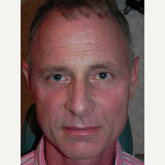 45-54 year old man treated with Sculptra after 1947508