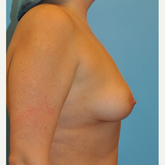 34 year old. B to full C cup. Silicone implants before 3344666