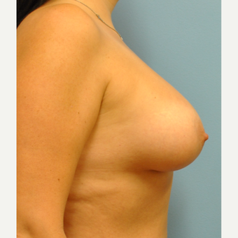 34 year old. B to full C cup. Silicone implants after 3344666