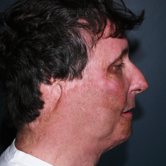 Burn scars can be Very devastating. However, they can be improved. after 3841065