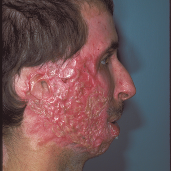 Burn scars can be Very devastating. However, they can be improved. before 3841065