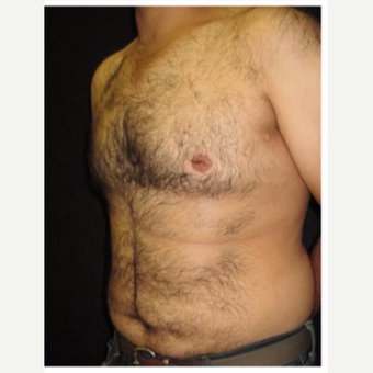25-34 year old man treated with Male Breast Reduction after 3185997