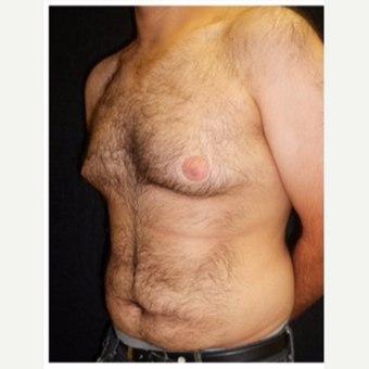 25-34 year old man treated with Male Breast Reduction before 3185997
