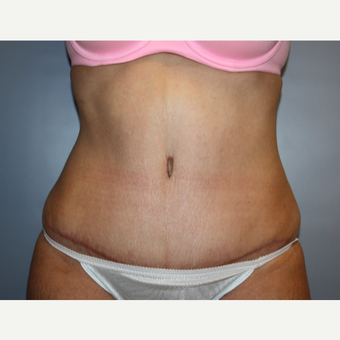 35-44 year old woman treated with Tummy Tuck after 3683085
