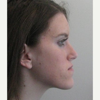 17 year old female Jaw Reduction before 2181859