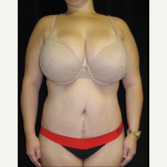 25-34 year old woman treated with Tummy Tuck Revision after 2848165