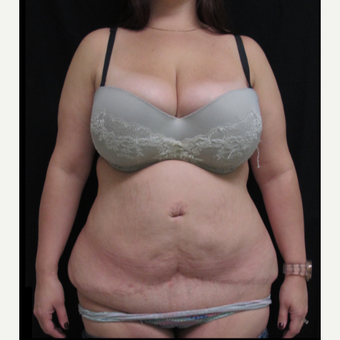 25-34 year old woman treated with Tummy Tuck Revision before 2848165