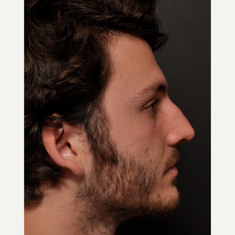 Functional Rhinoplasty with Subtle External Changes before 3645113