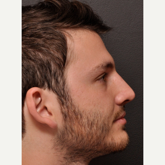 Functional Rhinoplasty with Subtle External Changes after 3645113