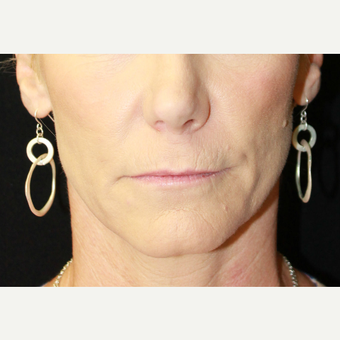 35-44 year old woman treated with Lip Implants before 3741785