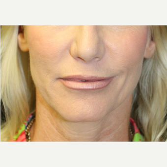 35-44 year old woman treated with Lip Implants after 3741785