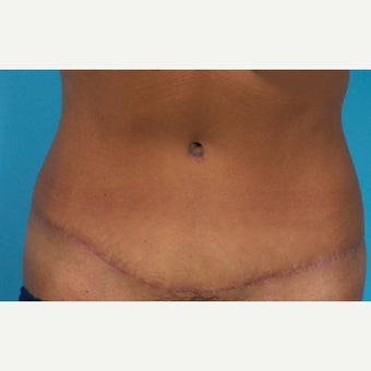 43 Year Old Woman Treated With Painless/Drainless Abdominoplasty - 5 Months Post-Op after 2227561