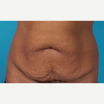 43 Year Old Woman Treated With Painless/Drainless Abdominoplasty - 5 Months Post-Op before 2227561