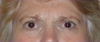 Blepharoplasty after 201521