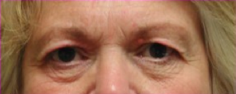 Blepharoplasty before 201521