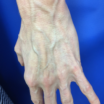 55-64 year old woman treated with Vein Treatment before 3079346