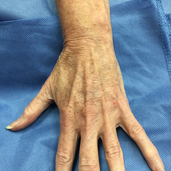 55-64 year old woman treated with Vein Treatment after 3079346