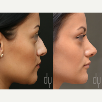 Primary Open Rhinoplasty and Septoplasty before 3322583