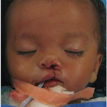 Cleft Lip And Palate Repair after 3711069