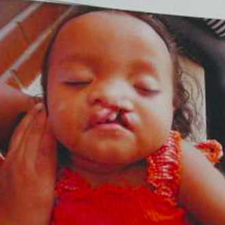 Cleft Lip And Palate Repair before 3711069