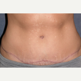 35-44 year old woman treated with Tummy Tuck & Liposuction to Hips after 3453650