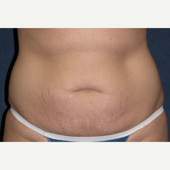 35-44 year old woman treated with Tummy Tuck & Liposuction to Hips before 3453650