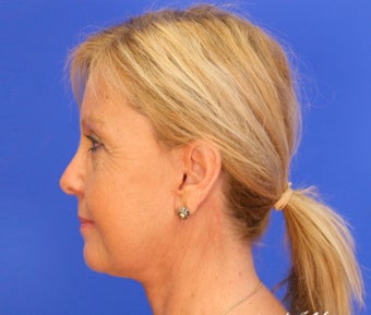 45-54 year old woman treated with Facelift after 3499936