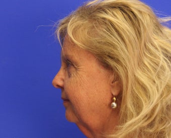 45-54 year old woman treated with Facelift before 3499936