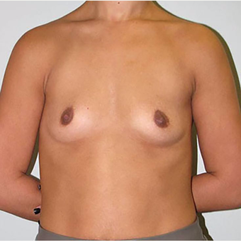 25-34 year old woman treated with Breast Augmentation before 3203102