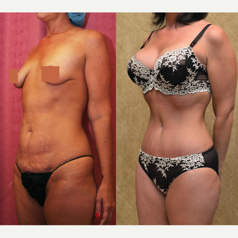 35-44 year old woman treated with Tummy Tuck after 3312089