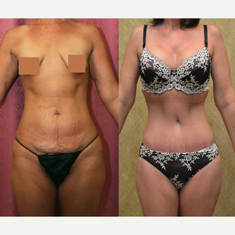 35-44 year old woman treated with Tummy Tuck before 3312089