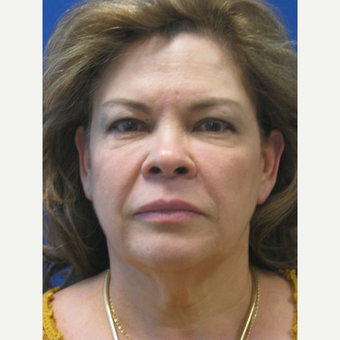 45-54 year old woman treated with Lifestyle Lift before 3802659