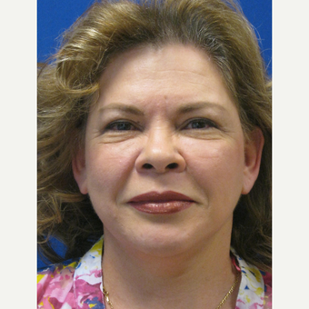 45-54 year old woman treated with Lifestyle Lift after 3802659