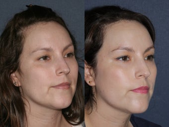 Before & After Laser Resurfacing before 806230