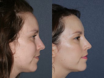Before & After Laser Resurfacing after 806230