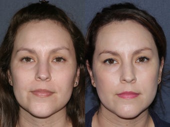 Before & After Laser Resurfacing 806230