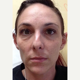 25-34 year old woman treated with Liquid Facelift before 3504928