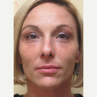 25-34 year old woman treated with Liquid Facelift after 3504928