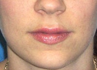 Juvederm Lip Enhancement after 52524