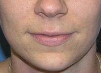 Juvederm Lip Enhancement before 52524