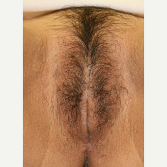 35-44 year old woman treated with Vaginal Rejuvenation after 2863811