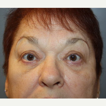 65-74 year old woman treated with Eyelid Surgery after 3709171