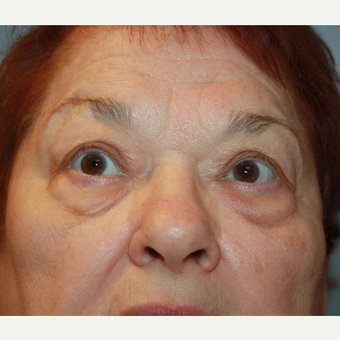 65-74 year old woman treated with Eyelid Surgery before 3709171