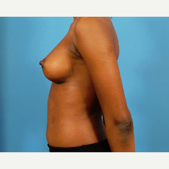 18-24 year old woman treated with Breast Augmentation after 3786961