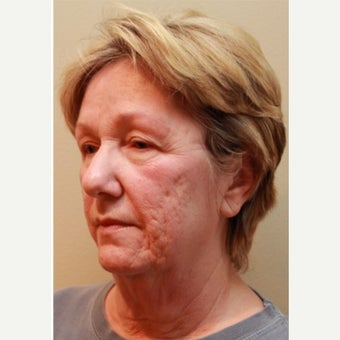 65-74 year old woman treated with Acne Scars Treatment before 2168209
