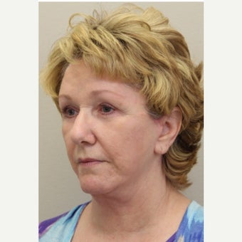 65-74 year old woman treated with Acne Scars Treatment after 2168209