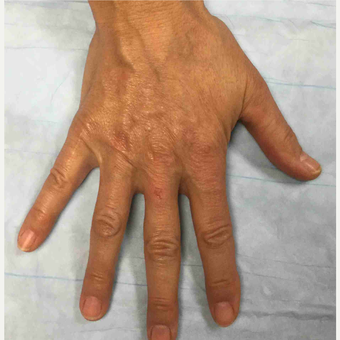 45-54 year old woman treated with Radiesse to her hands after 3169276