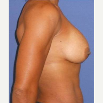 Subglandular Breast Augmentation after 3650822